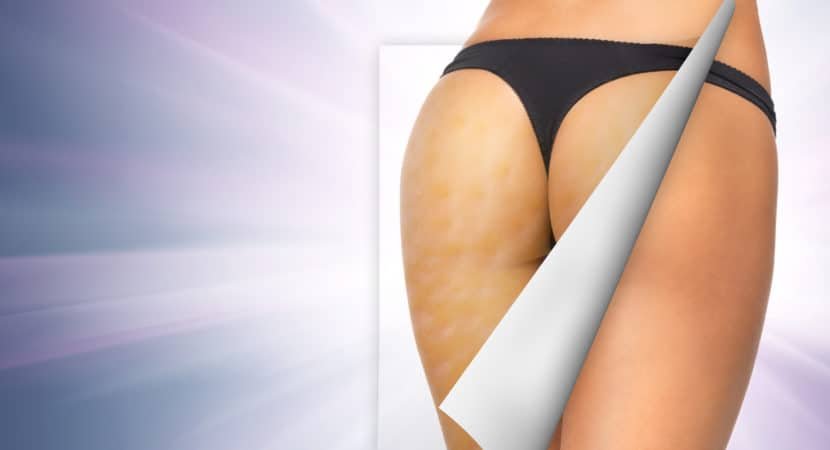 8 worst foods that cause cellulite and what you can do about it why does cellulite form